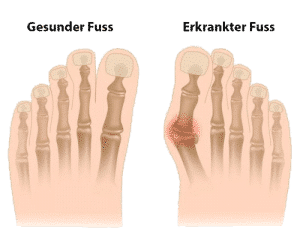 hallux_valgus_verformung