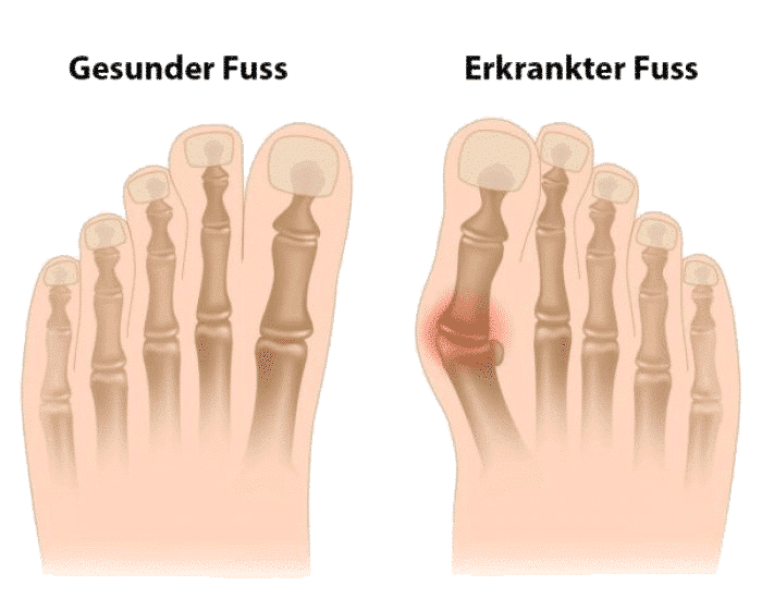 hallux_valgus_verformung
